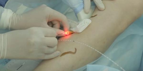Varicose Vein Treatment Devices Market Analysis Report By Key Players-  AngioDynamics, Lumenis, Syneron, Biolitec - Global Forecast