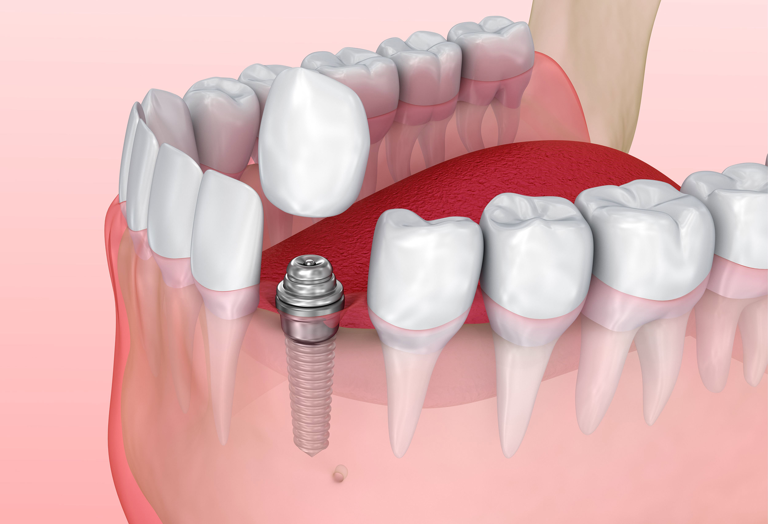Dental Implants vs. Crowns: Which is Better for You