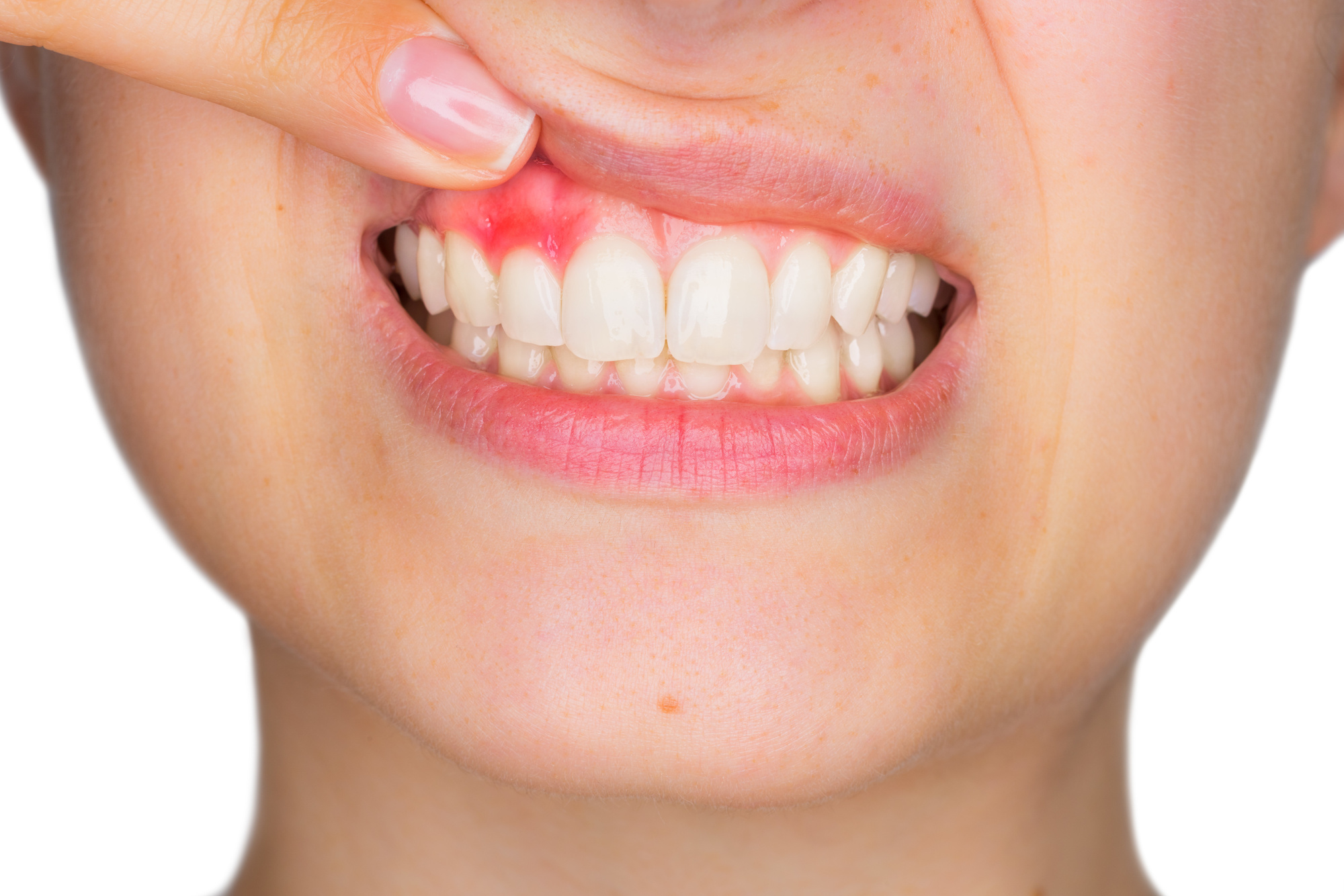 What Deficiency Causes Bleeding gums?