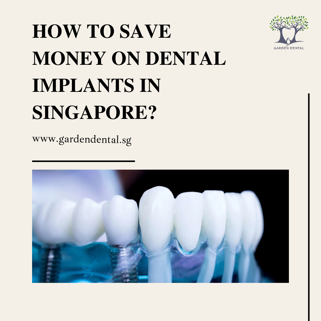 How to Save Money on Dental Implants in Singapore