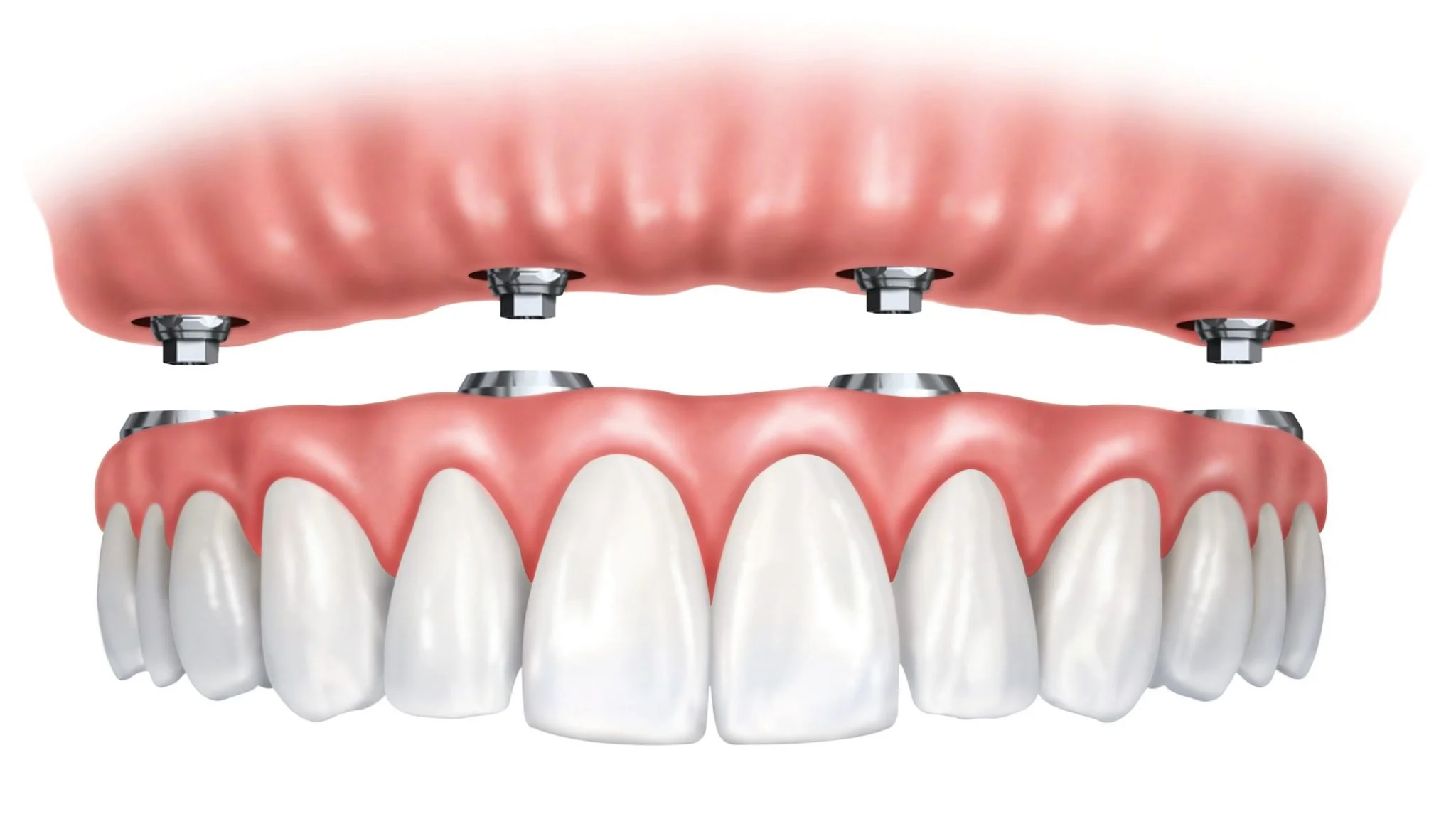 Implant dentures: Secure, comfortable, and long-lasting solutions in Chatham-Kent
