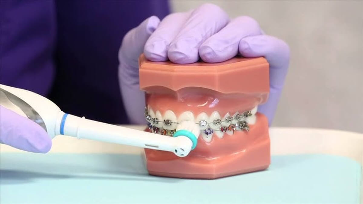 Can You Use An Electric Toothbrush With Braces?