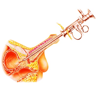 Prostate Cancer and Fertility: What Should You Know?