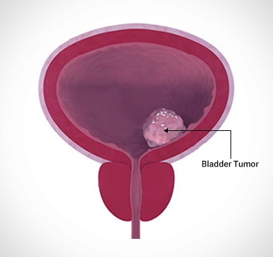 Bladder Cancer: Symptoms, Diagnosis and Treatment