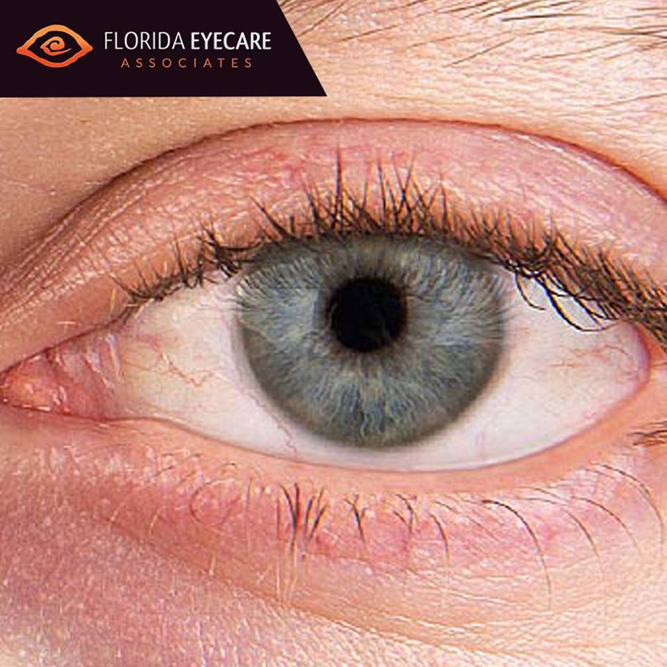 Scleral Lens Treatment Miami
