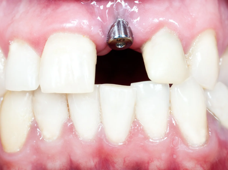 Dental Implant Success Rate and Why It’s a Trusted Solution