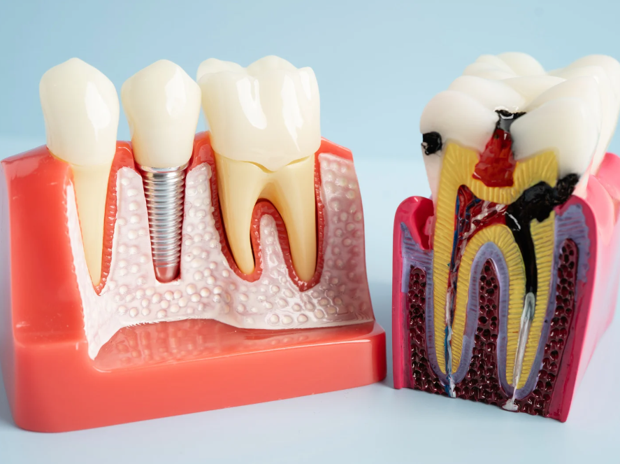 Beyond Fillings: Why Dental Implants Is the Future of Restorative Dentistry