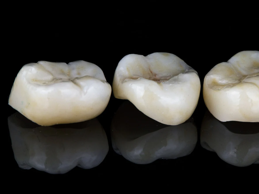 Dental Crown Types Explained: Porcelain, Metal, and Ceramic