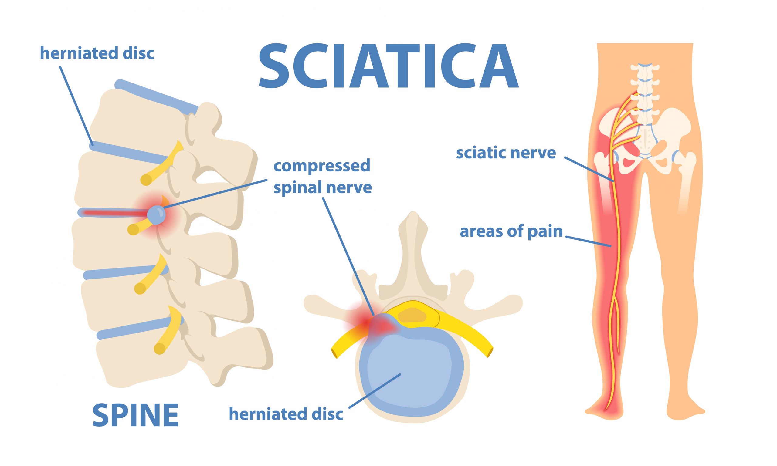 Sciatica: Causes, Symptoms, and Treatment Options by Dr. Priyank Patel