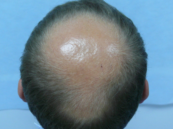 Androgenetic Alopecia Treatment Options: Which One is Right for You?