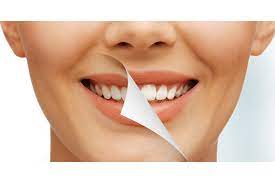 Teeth whitening for special occasions: Is it worth the investment?