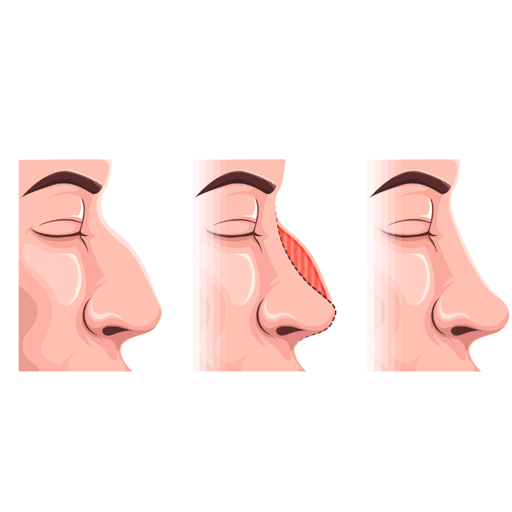 HOW IS RHINOPLASTY (NOSE JOB) DONE?
