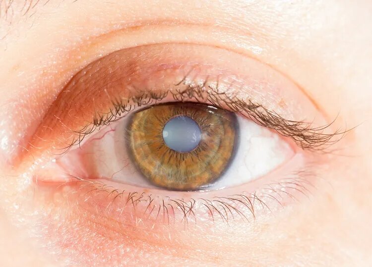 Cataract Eye Surgery Hospital in Delhi