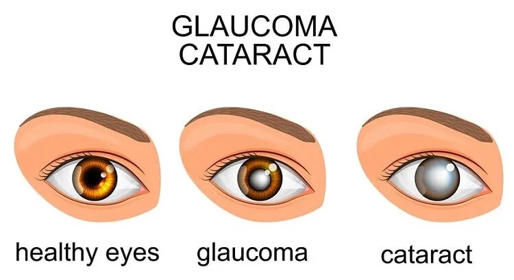 Best Glaucoma Eye Surgery in Delhi