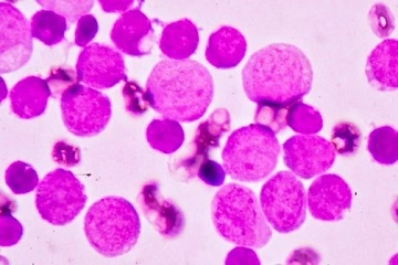 The Transformative Growth of the US Acute Myeloid Leukemia Market