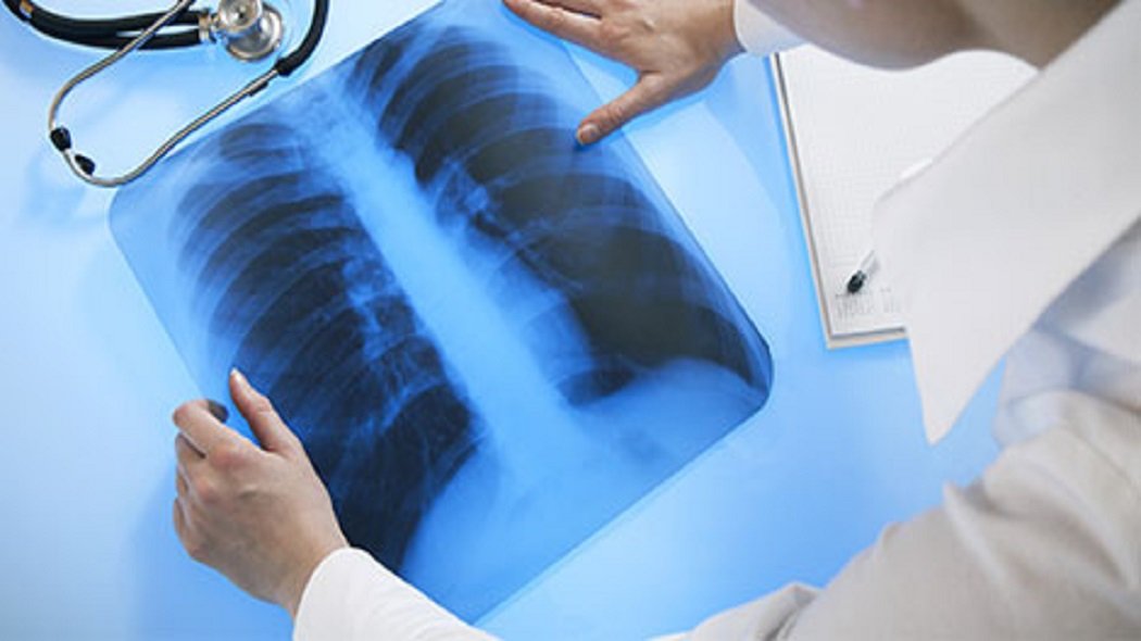 Revolutionizing Lung Cancer Diagnosis and Screening Market: A Market Overview