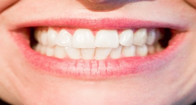 Signs It’s Time to Replace Your Porcelain Veneers