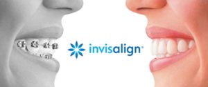 Straighten Your Smile: The Rise of Invisalign in The Colony