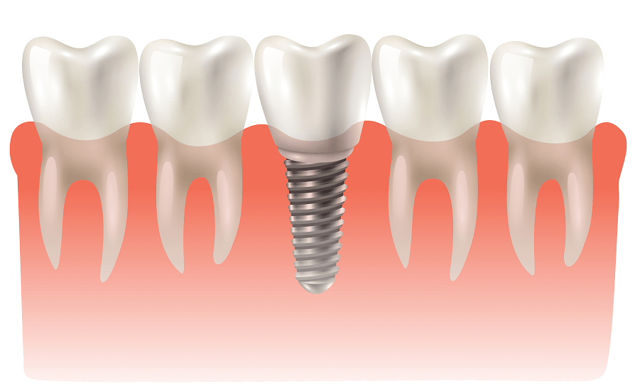 Find The Best Crowns and Bridges Specialist in The Colony