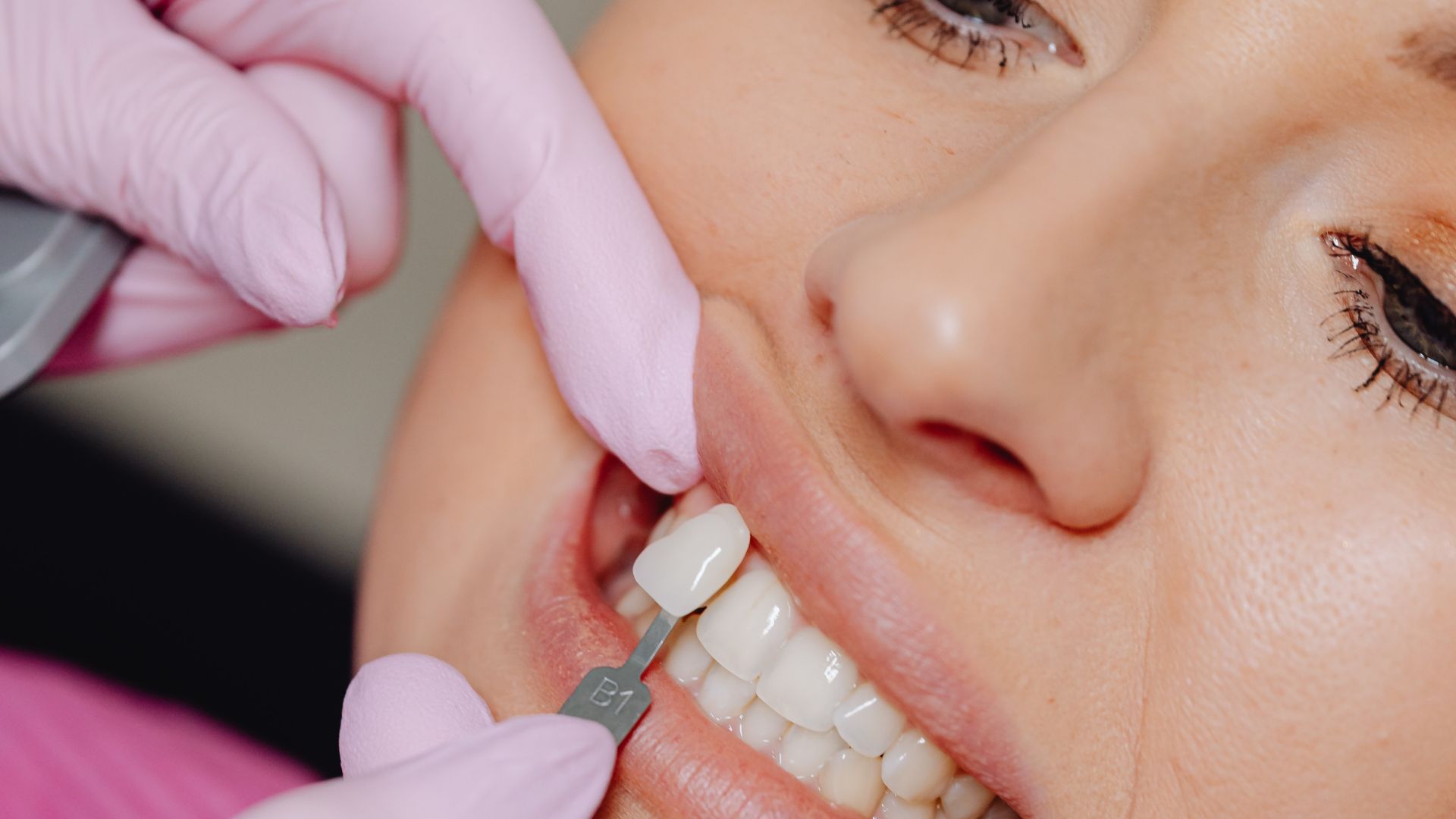 Exploring the Process of Getting Porcelain Veneers in Dallas
