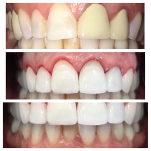 Tips for Finding an Affordable Dentist in Frisco