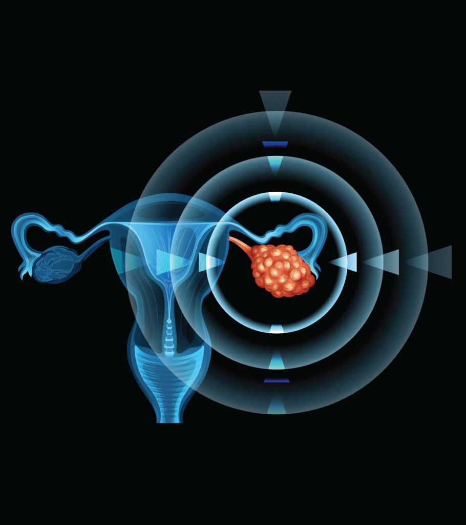 Ovarian Cancer Treatment Drugs Market 2022 Size, Growth & Forecast Report  