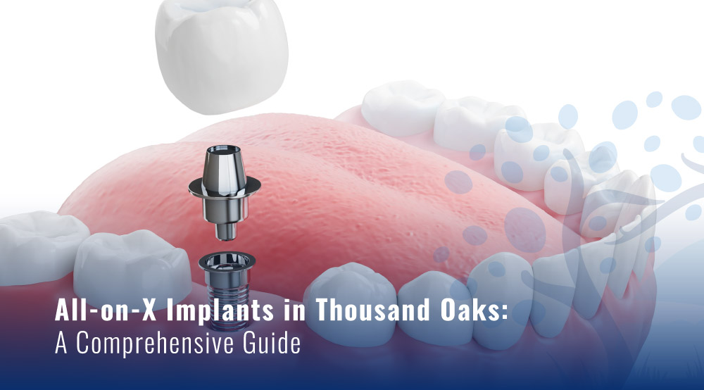 All-on-X Implants in Thousand Oaks: A Comprehensive Guide