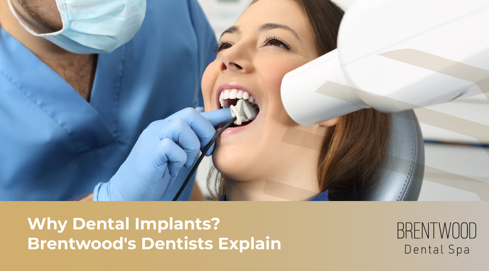 Why Dental Implants? Brentwood's Dentists Explain