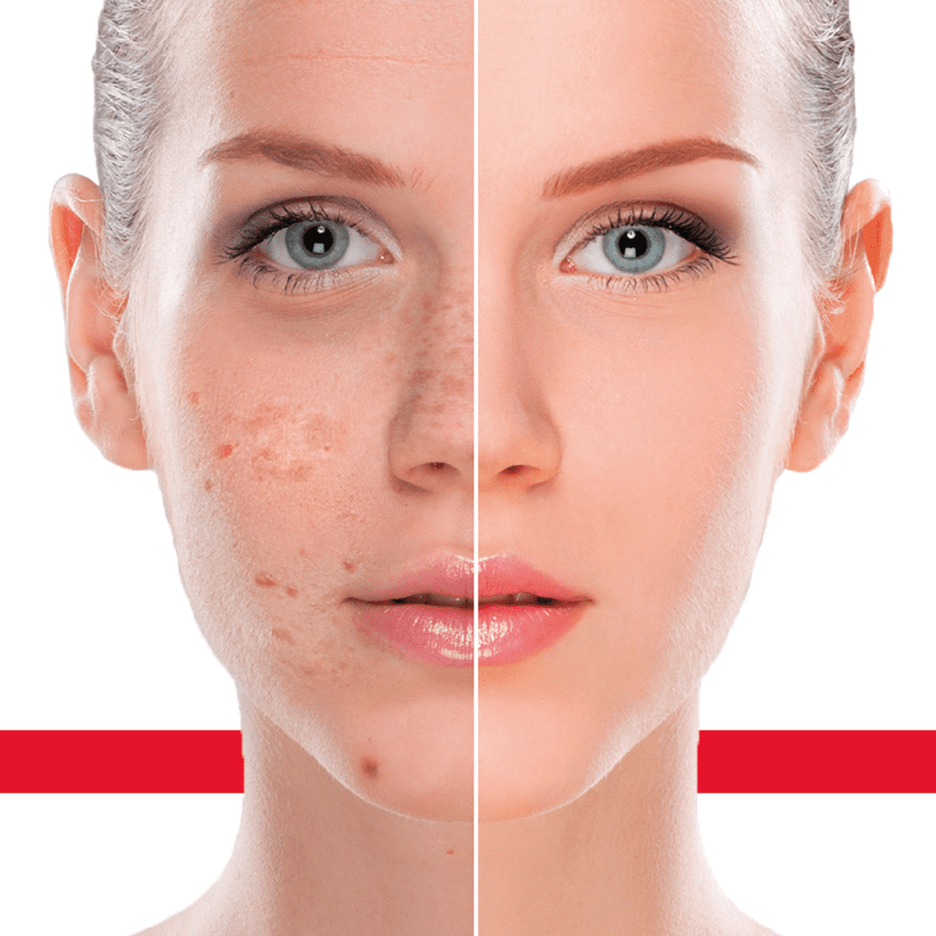 The Journey to Clear Skin: Navigating Pigmentation Disorders Treatment 