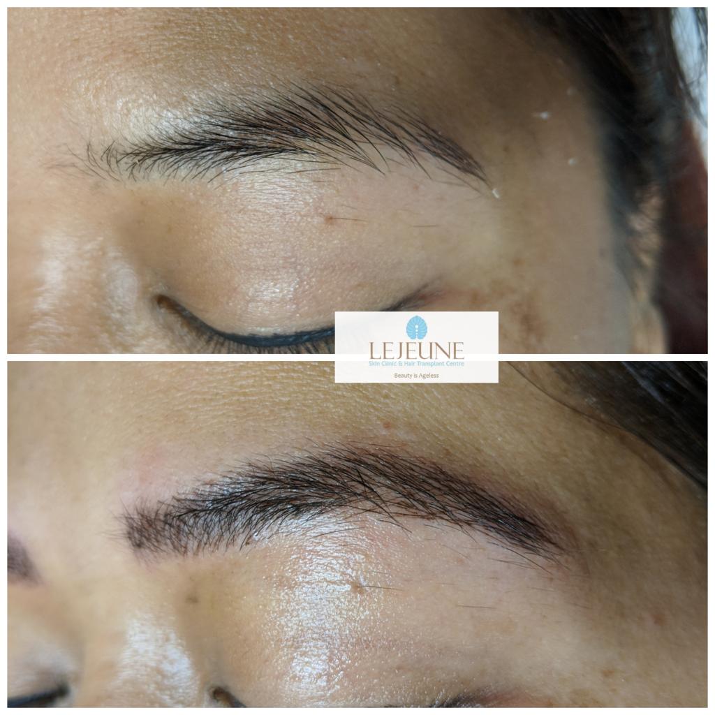 Microblading treatment at Le Jeune Medspa