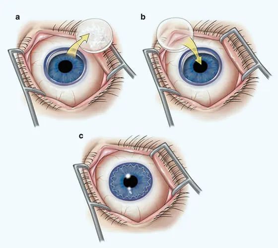 Best Hospital For Cornea Transplant Treatment