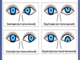 Best Squint Eye Surgery In Delhi