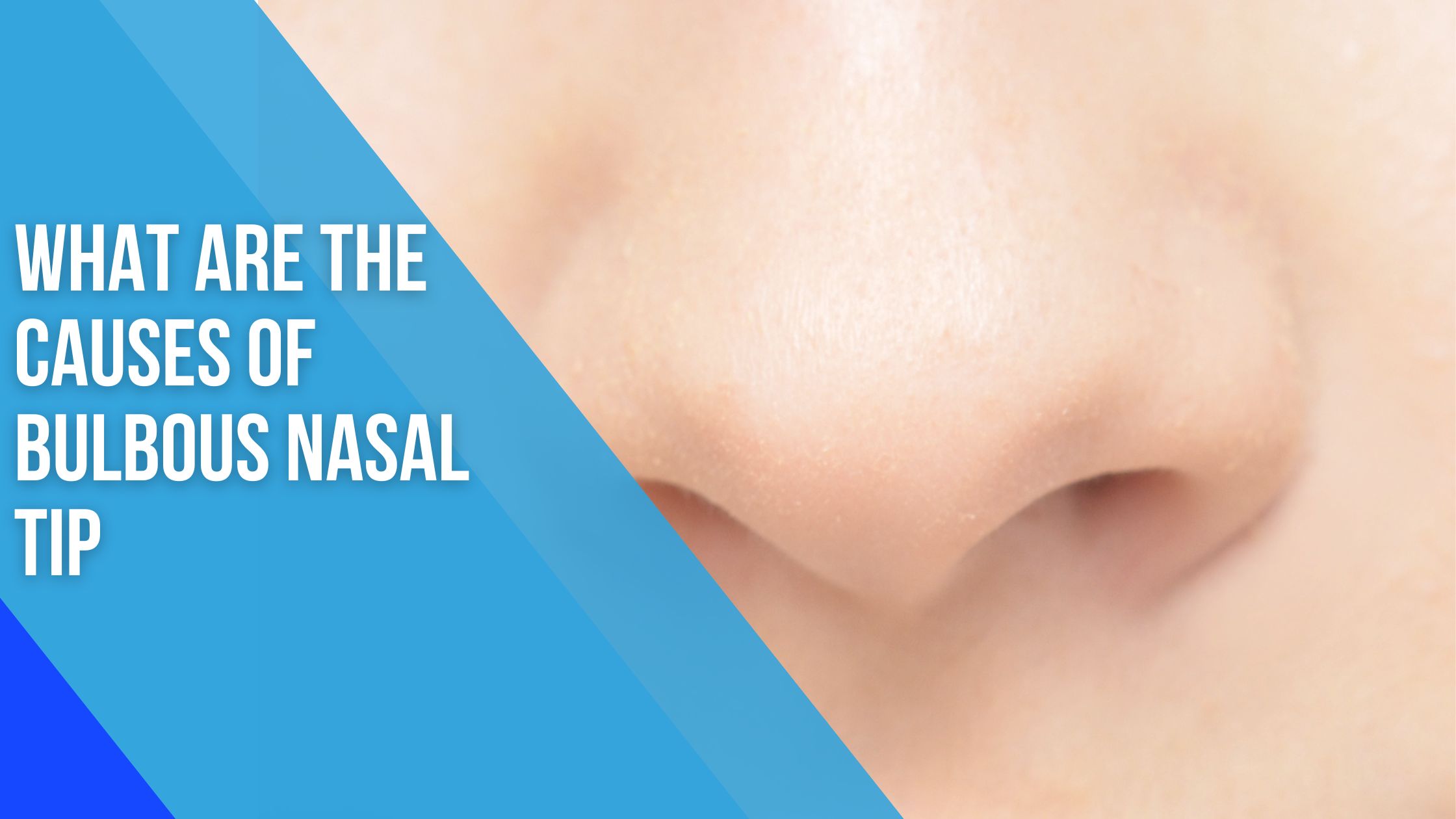 Bulbous Nose Job: Maximize Your Natural Beauty with Nasal Tip Surgery