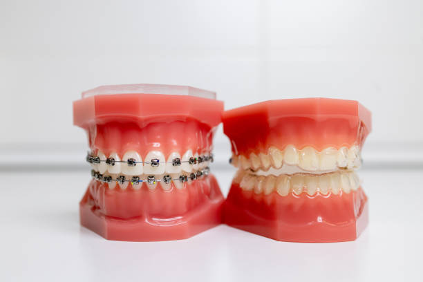 Understanding the Distinctions Between Invisalign and Retainers