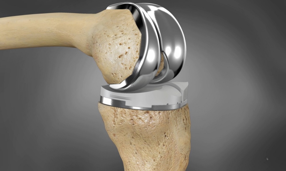 Global Artificial Knee Joint Market 2022 - Top Key Players Analysis Report Till 2030