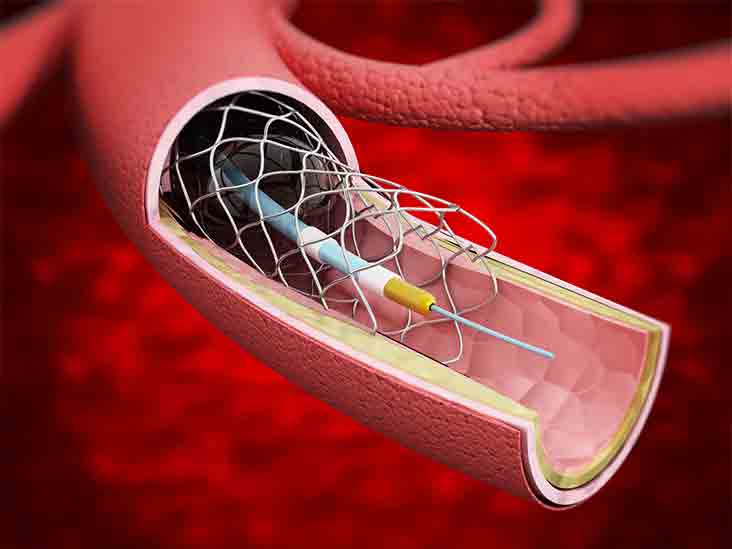Non-vascular Stents Market Size, Share, Growth, Opportunities and Global Forecast to 2030
