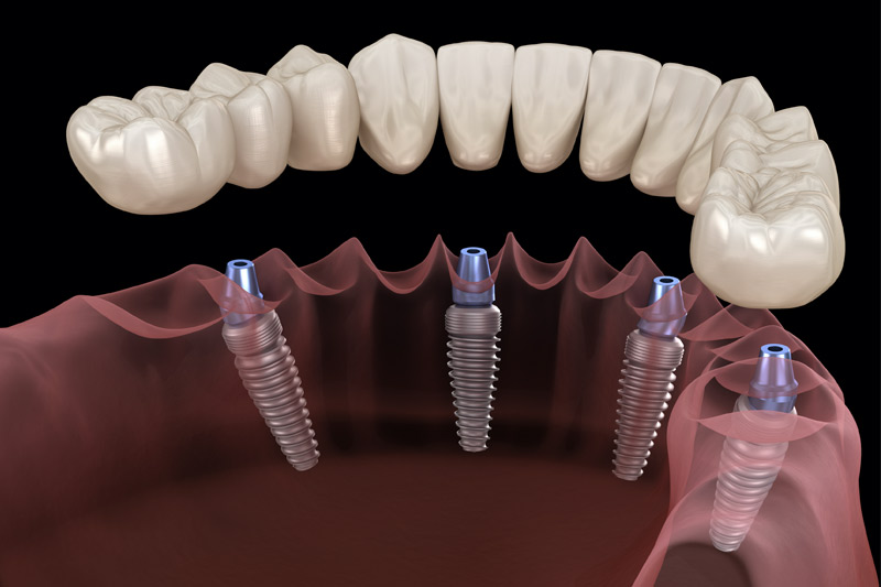 The Procedure Of All on Four Implants