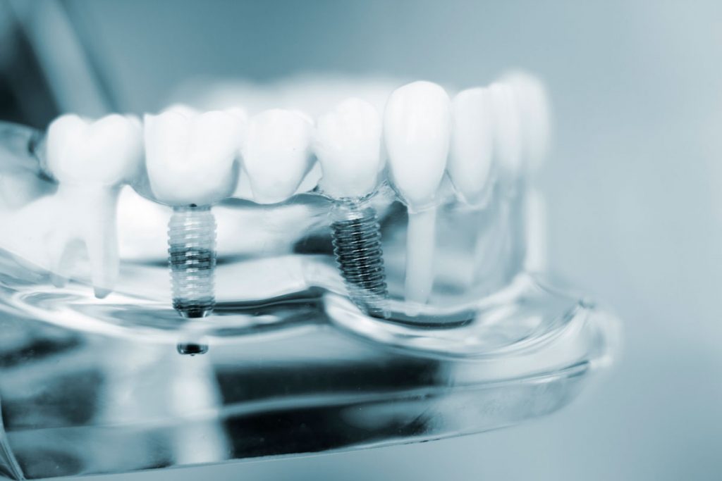 The Ultimate Guide to Understanding the Cost of Dental Implants