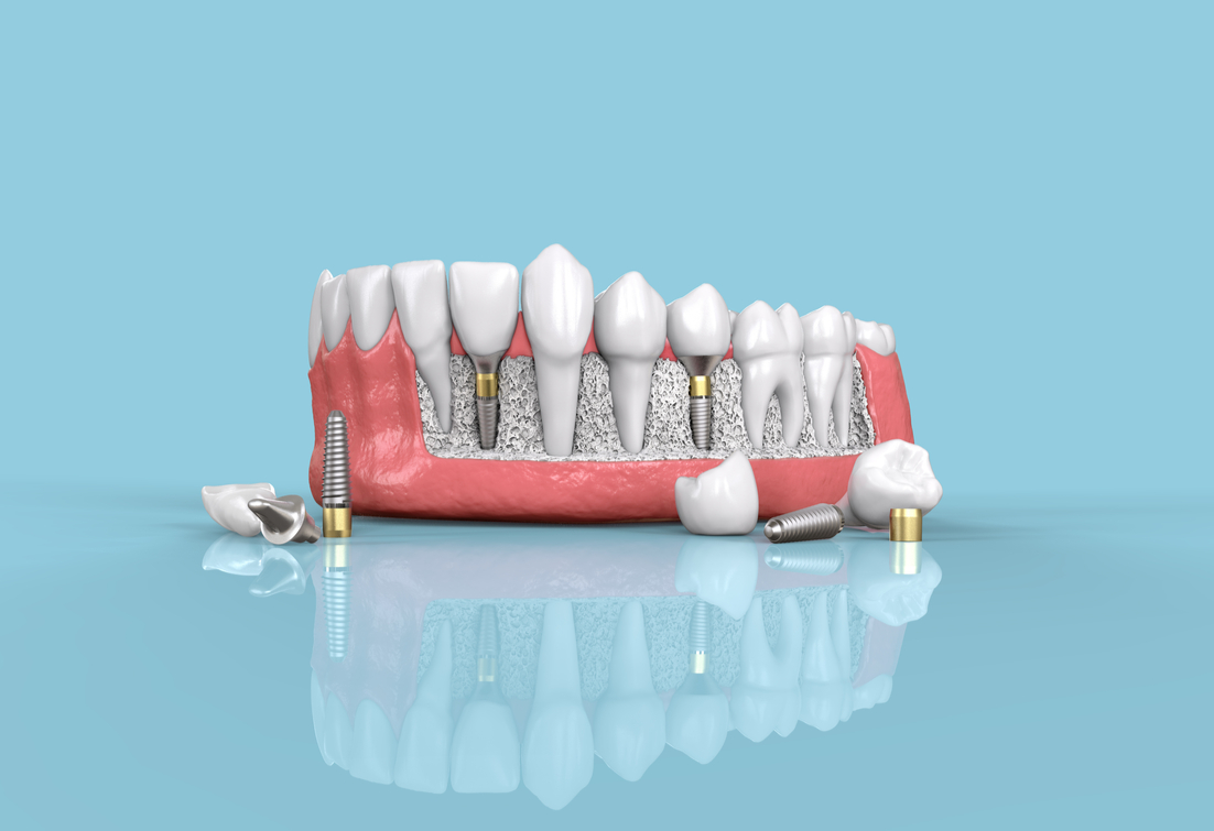 Transforming Smiles with Dental Implants in Tallahassee, FL