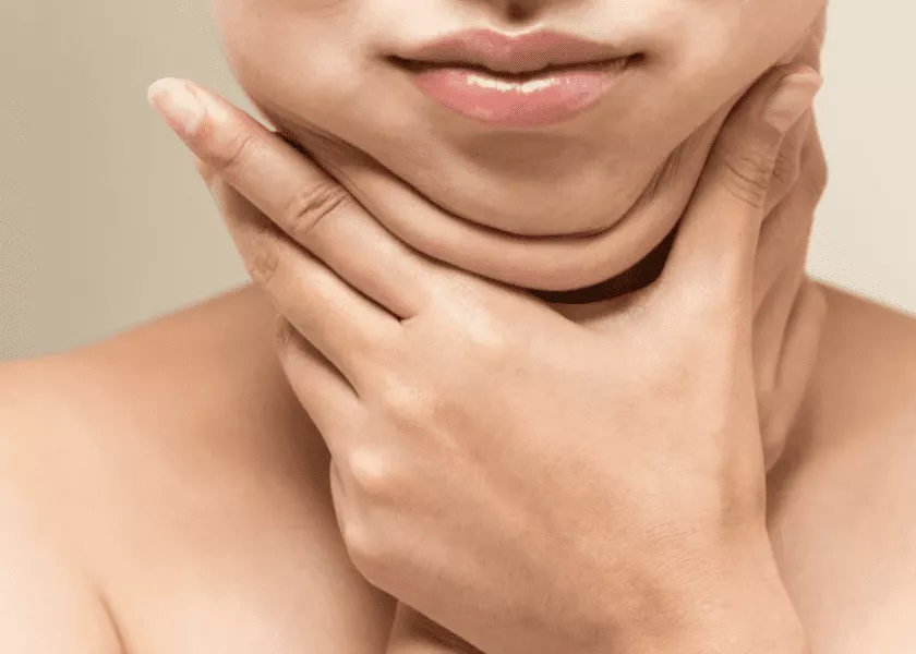 Double chin liposuction 