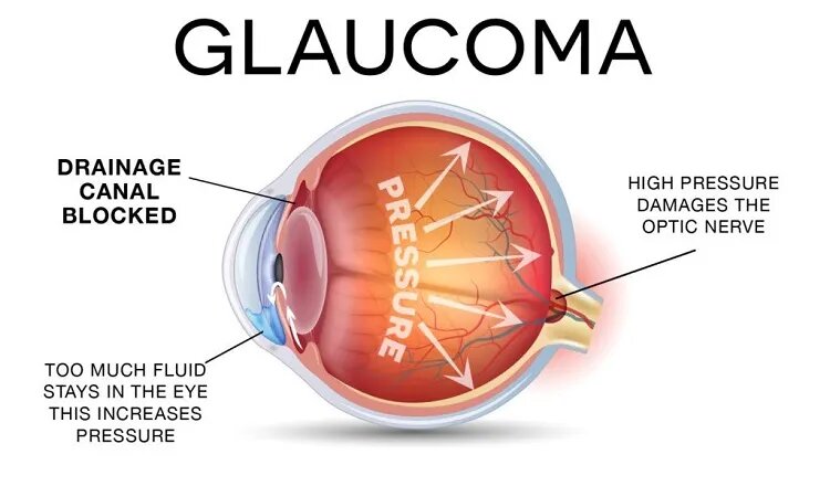 Sight Saver: Breakthroughs in Glaucoma Treatment
