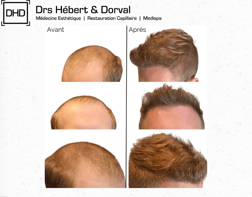 How To Avoid Hair Loss?
