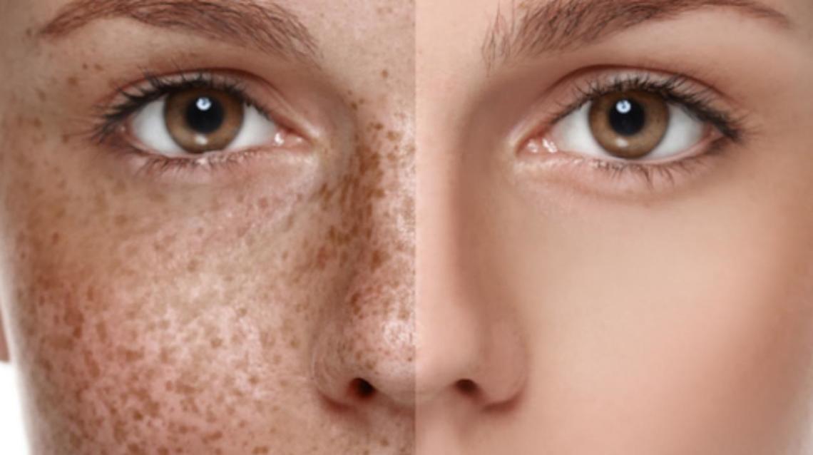 The Role Of Laser Therapy In Pigmentation Disorders Treatment