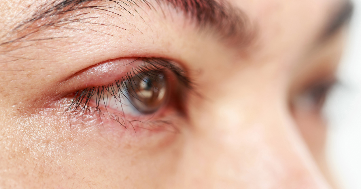 Exploring the Blepharitis Treatment Market: Current Scenario and Future Trends