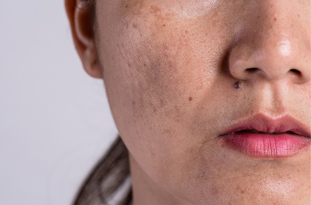 THE IMPACT OF MELASMA ON MENTAL HEALTH