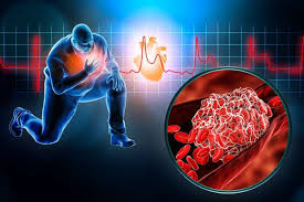 What happens if you don't treat a heart attack right away?