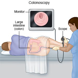 Can I Get a Colonoscopy Without Insurance?