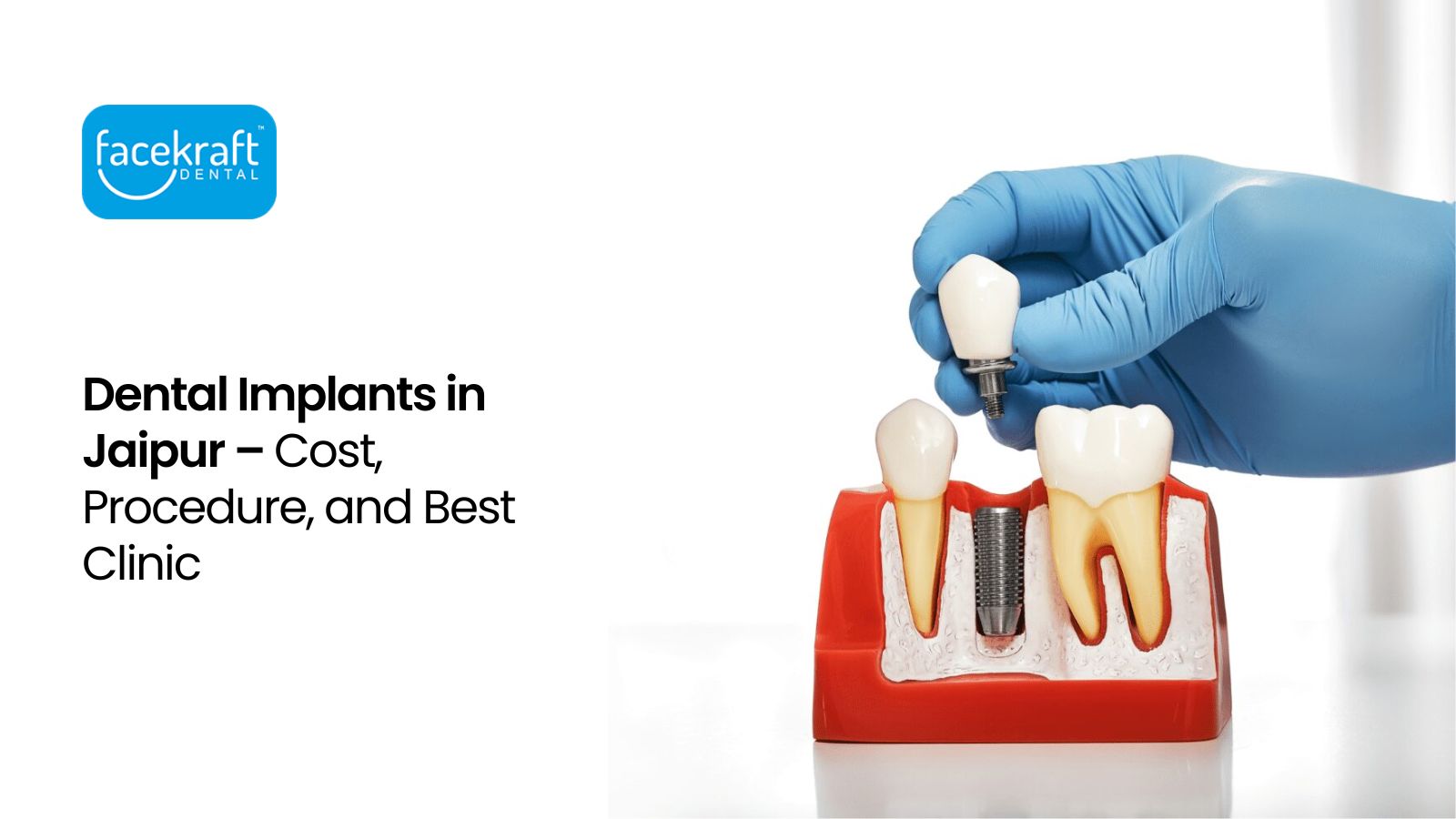 Dental Implants in Jaipur – Cost, Procedure, and Best Clinic