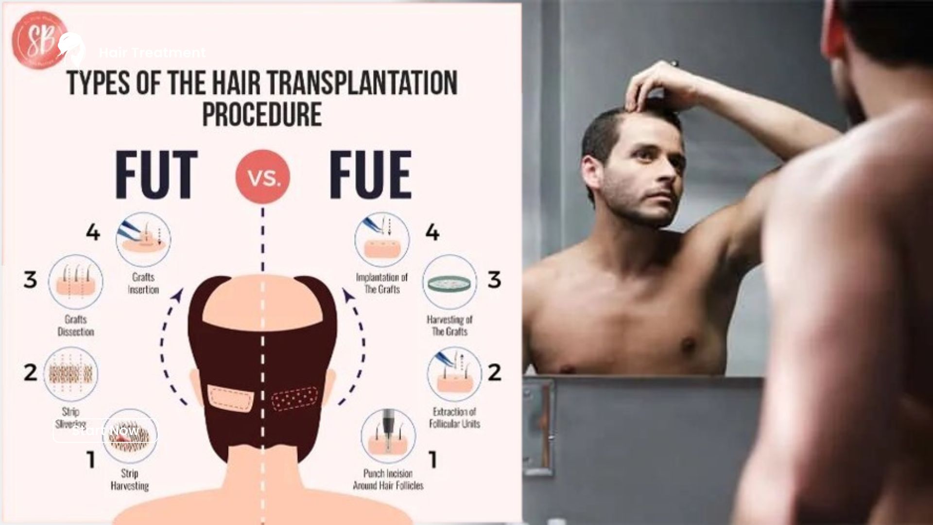 How Long Does Recovery After a Hair Transplant Take?