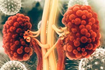 What Foods To Avoid If You Have PKD?
